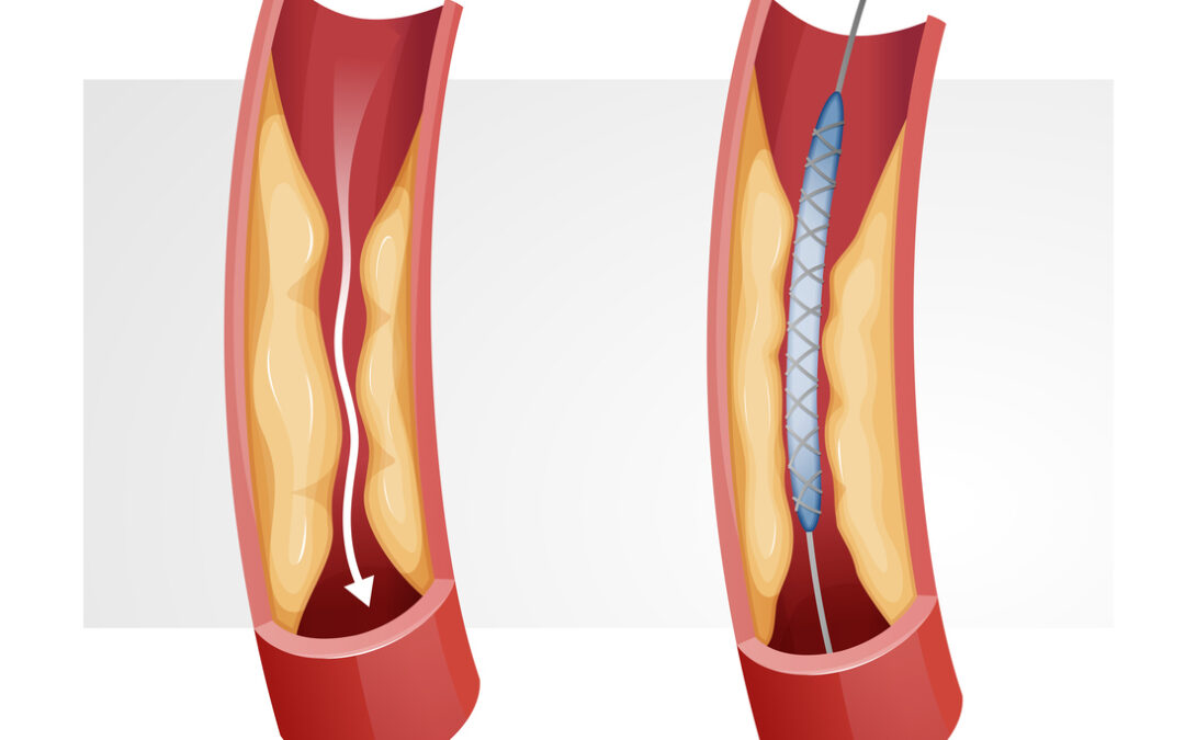 Medtronic HawkOne System Lawsuit