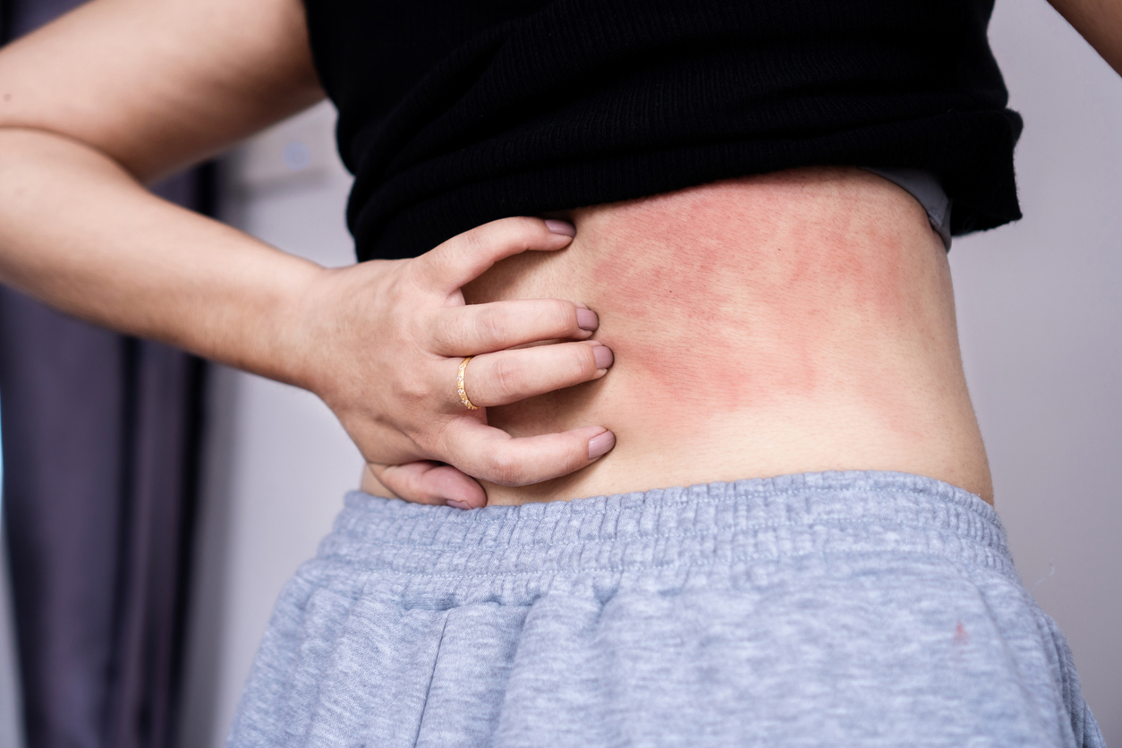 T Cell Skin Rash Cutaneous T Cell Lymphoma Buttocks