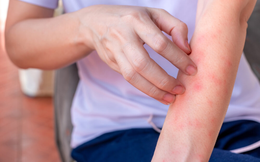 Erythema Multiforme Lawsuit