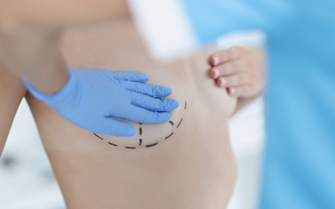 Internal Bra Lawsuit