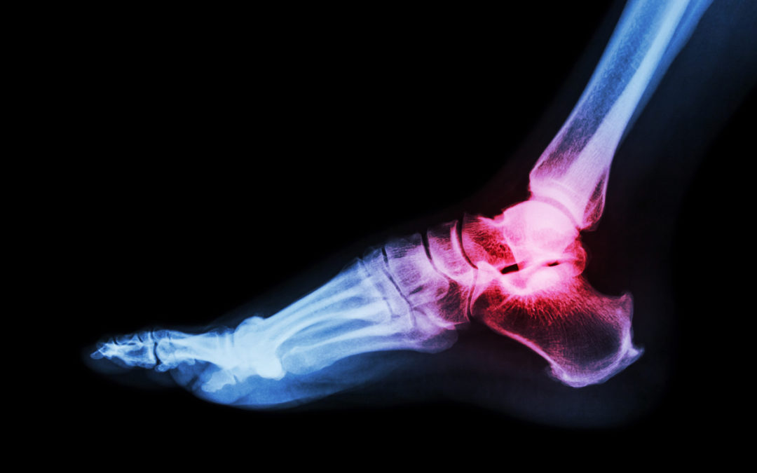 Ankle Replacement Class Action Lawsuit