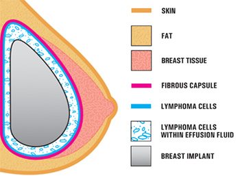 Breast Implant ALCL Lawyer and Lawsuits