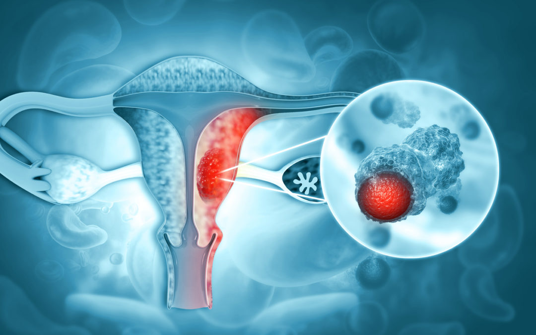 Endometrial Cancer Lawsuit