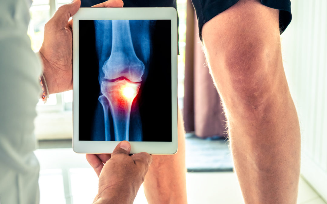 Exactech Knee Class Action Lawsuit