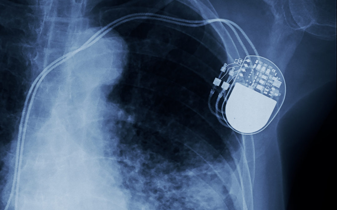 Medtronic Pacemaker Battery Drain Defect Linked to 1 Death