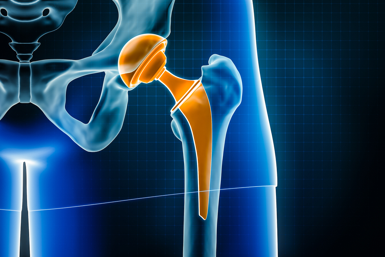 Biomet Hip Recall